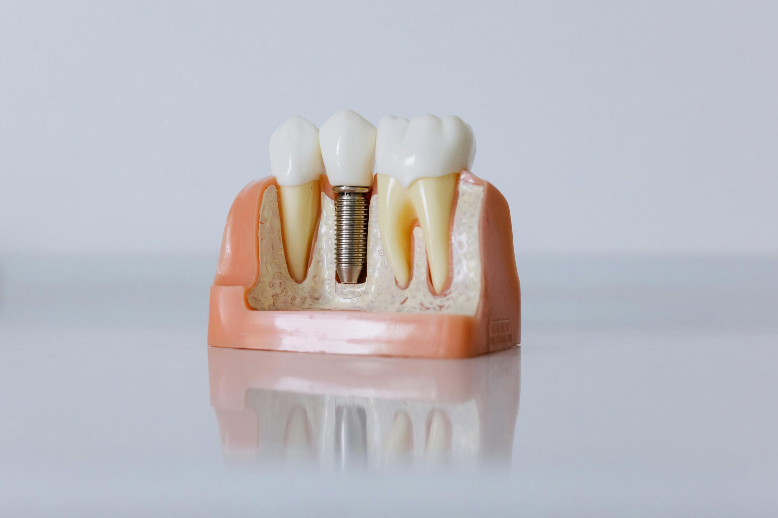 Implantes de carga inmediata